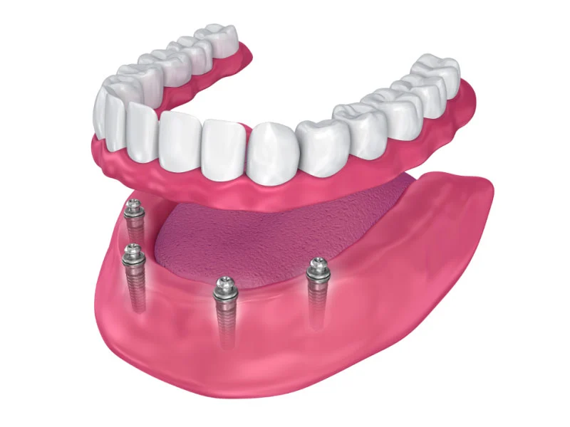 Çene kemiğindeki implantlara bağlanan implant üstü protez