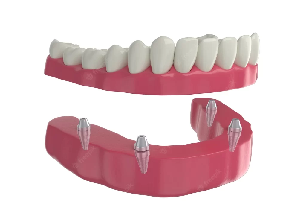 Tam, bölümlü ve implant üstü protez diş çeşitleri