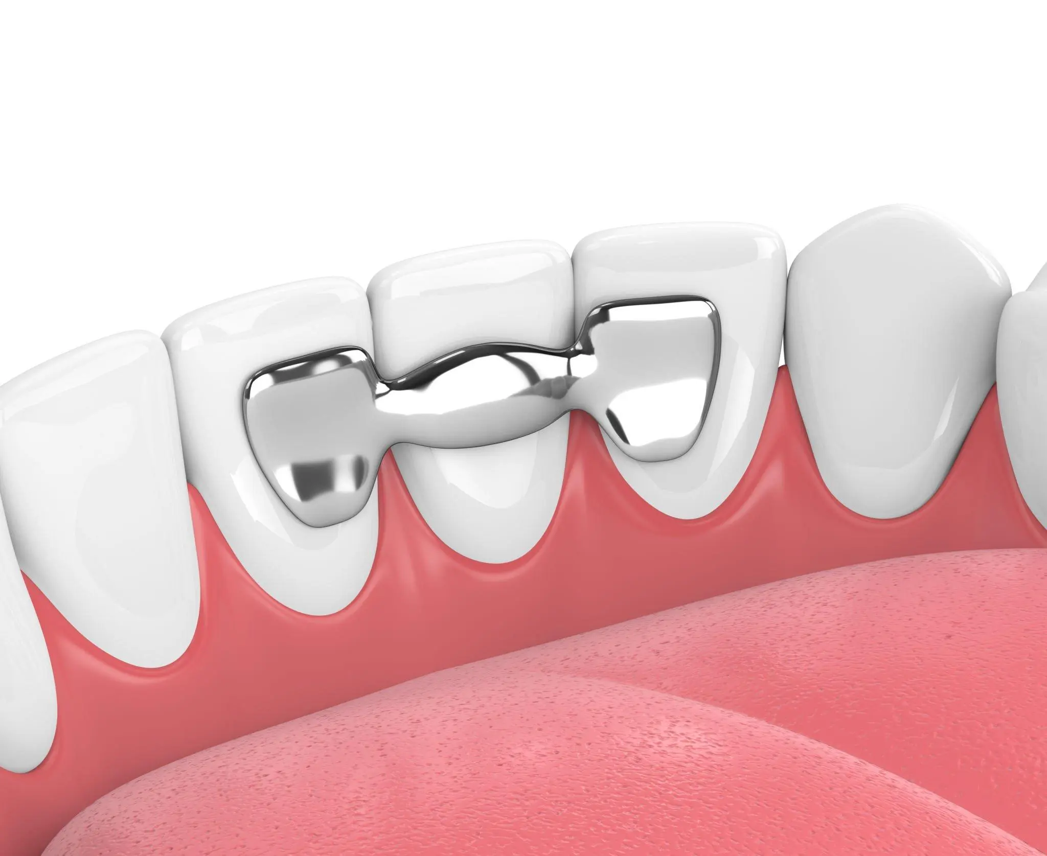 Destek dişlere sabitlenen köprü diş uygulaması