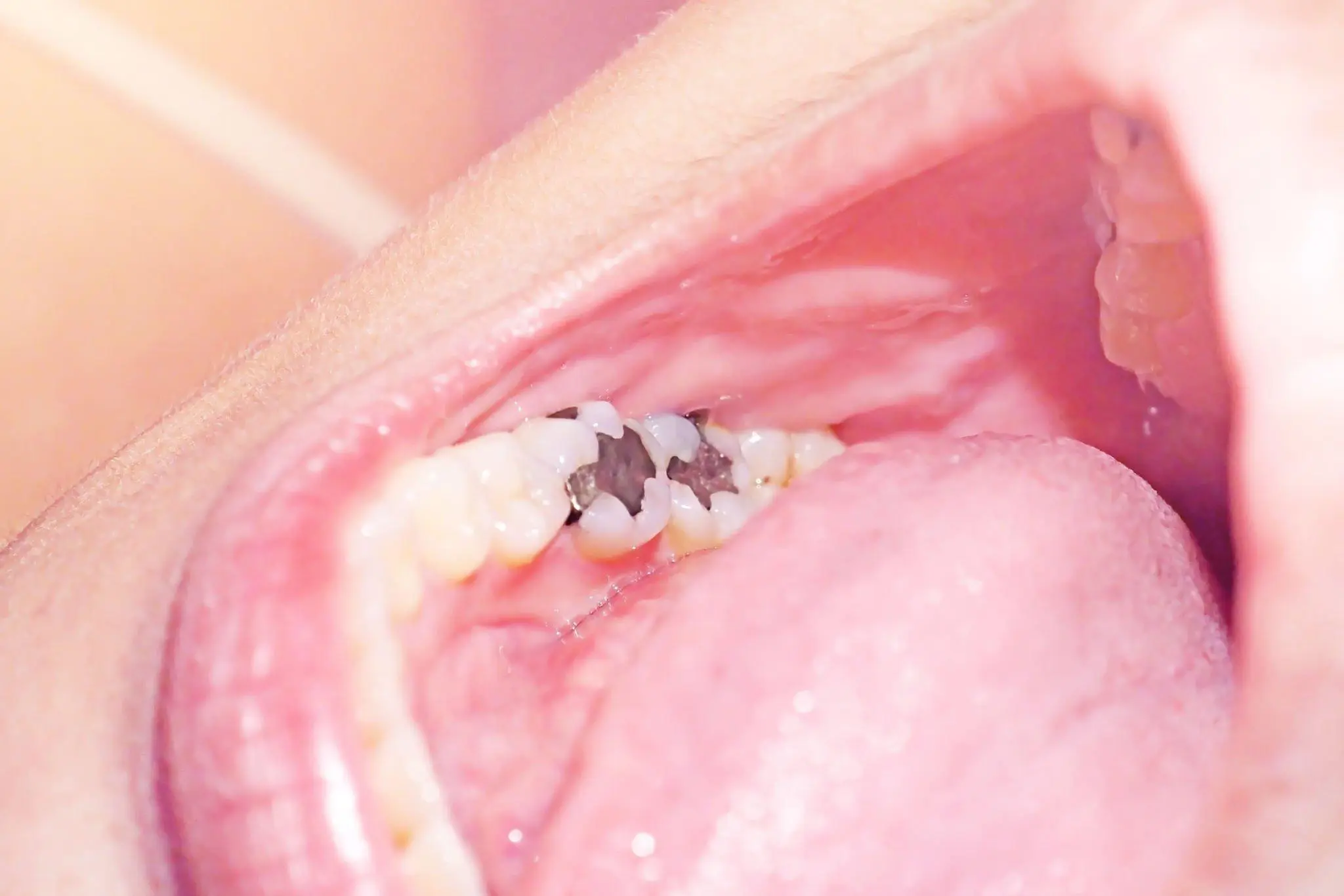 Arka azı dişinde gri metalik amalgam (gümüş) dolgu fotoğrafı