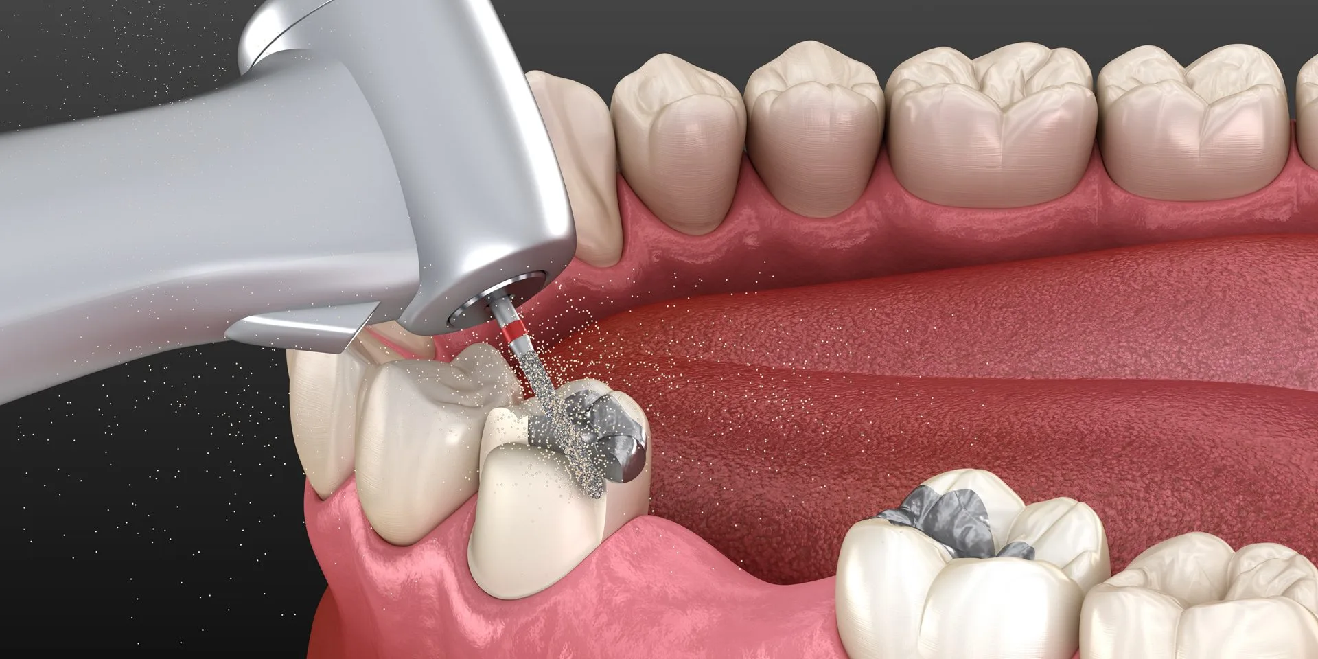Amalgam dolgu ile diş renginde kompozit dolgunun karşılaştırması