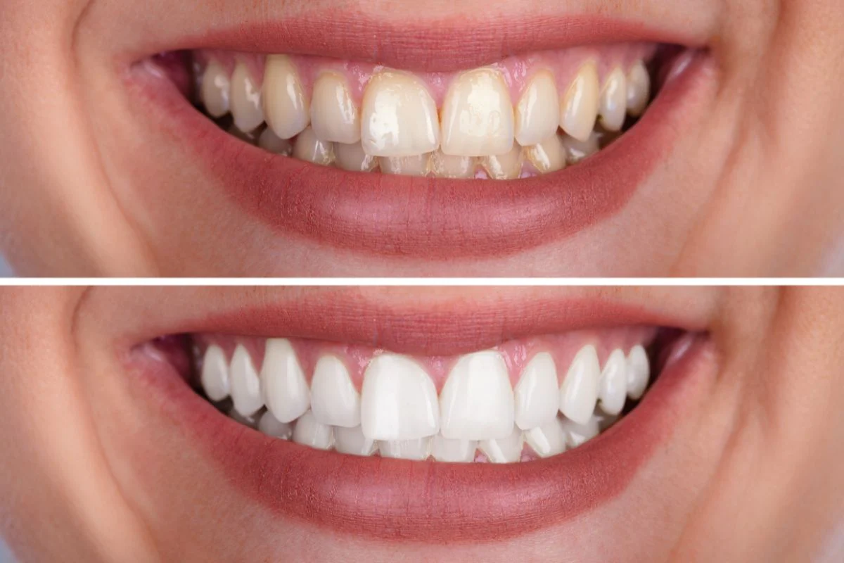 Diş minesi, dentin ve pulpa katmanlarını gösteren diş kesiti