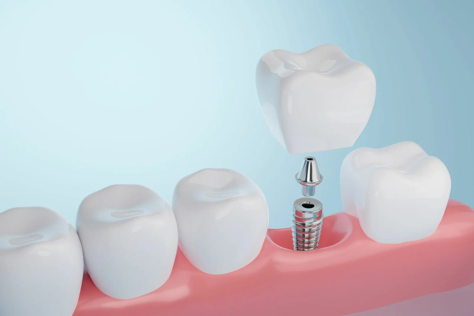 Diş eksikliği bulunan çenede implant üstü kron uygulamasının şeması