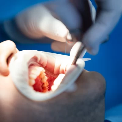Endodonti tedavisinde kök kanallarının temizlenmesi