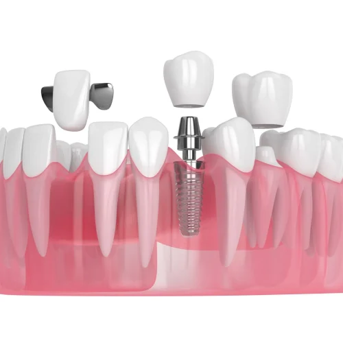 Geleneksel, adeziv ve implant destekli köprü diş çeşitleri