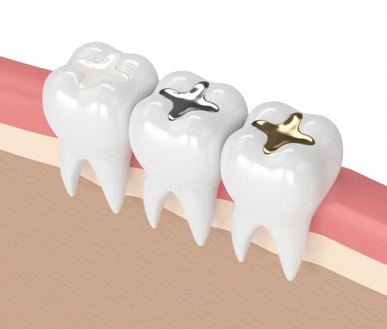 diş dolgusu çeşitlerinin görüntüsü